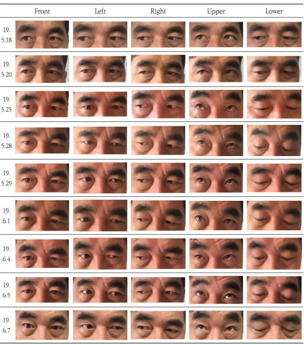 Fig.  1.  Changes  in  Both  Eye  Movement  according  to  Treatment  Duration.