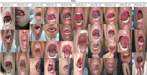 Fig.  1.  Images  of  the  oral  mucosa  lesions