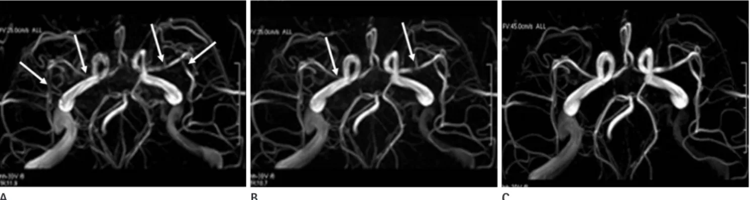 Fig. 6. Comparison of 3D PC MRAs by variable velocity encoding (VENC) values (25 cm/sec in A, 35 cm/sec in B, 45 cm/sec in C)