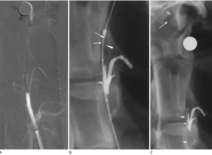 Fig. 2. Left vertebral angiogram using DSA shows complete occlusion of the artery (A)