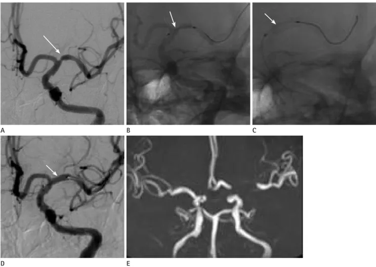 Fig. 1. 64 years old man who presented right side weakness and dysarthria. 
