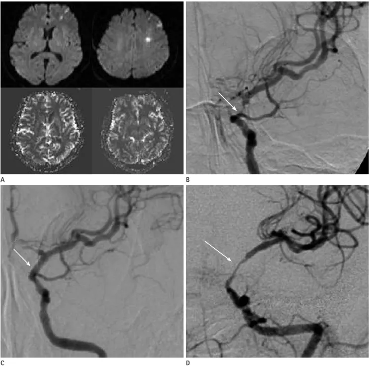 Fig. 2. 55 years old woman who presented motor weakness and sensory change. 