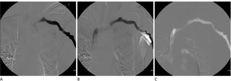 Fig. 2. Venogram of the left central vein in a 65-year-old man. 