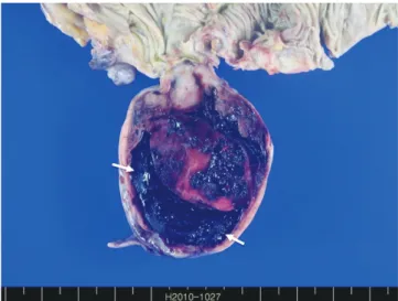 Fig. 3. Photomicrograph of histopathologic specimen shows that the  tumor cells are strongly reactive for C-Kit in immunohistochemical  stain (× 200).