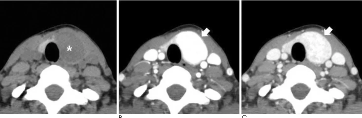 Fig. 1. Follicular thyroid carcinoma proven by surgical resection