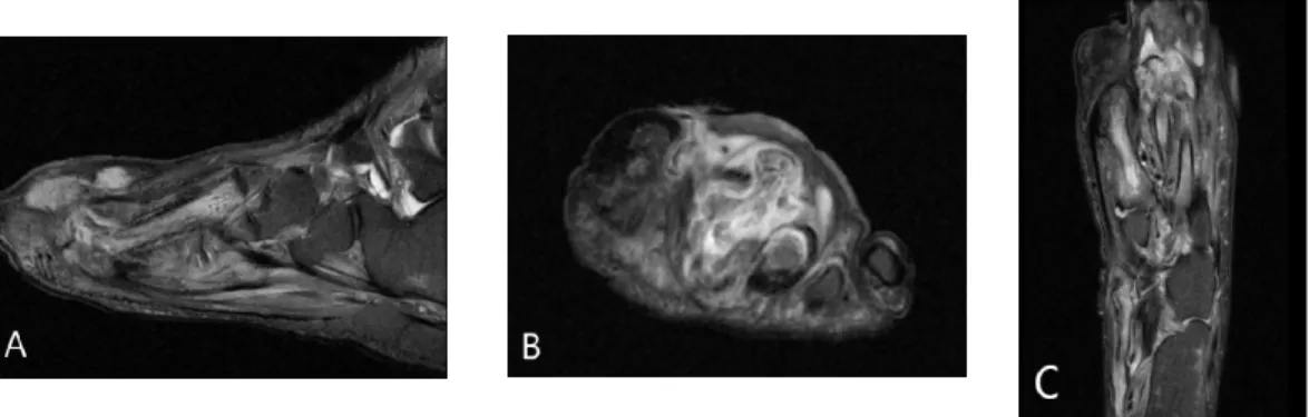 Fig.  2.  MRI  T2  image  of  sagittal  (Fig.  2-A),  coronal  (Fig.  2-B),  axial  (Fig