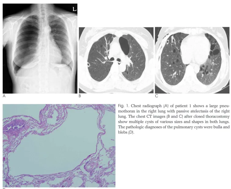 Fig.  1.  Chest radiograph (A) of patient 1 shows a large pneu- pneu-mothorax in the right lung with passive atelectasis of the right lung