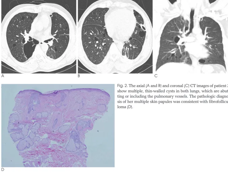 Fig. 2. The axial (A and B) and coronal (C) CT images of patient 2 show multiple, thin-walled cysts in both lungs, which are  abut-ting or including the pulmonary vessels