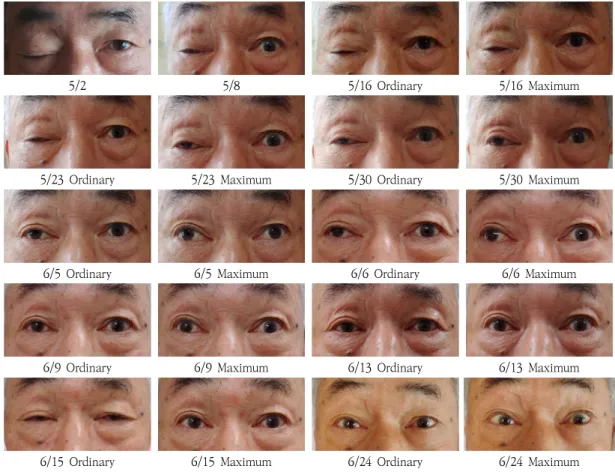 Fig.  2.  The  Progress  Photograph  of  Rt.  Ptosis 