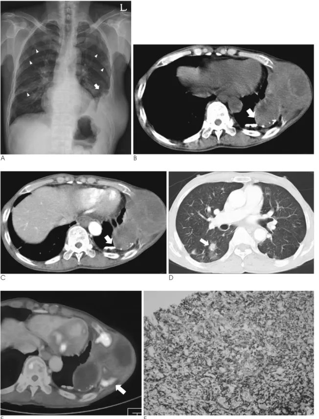 Fig. 1. A 66-year-old man with angiosarcoma of the chest wall and pulmonary metastases