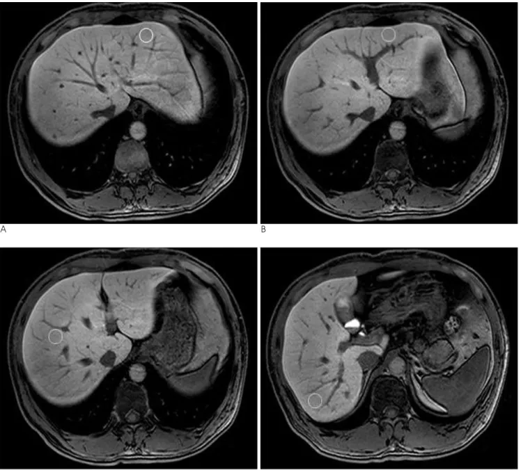 Fig. 1. A-D. The method for measuring the regions of interest at four points of the hepatic parenchyma in the right and left lobes of the liver