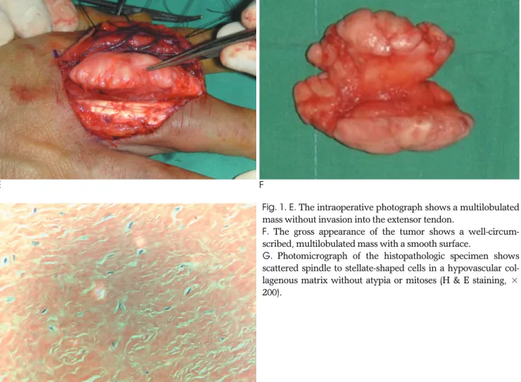 Fig. 1. E. The intraoperative photograph shows a multilobulated mass without invasion into the extensor tendon