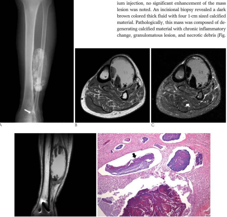 Fig. 1. A 73-year-old man with calcific myonecrosis presented as a painless, slowly enlarging mass on the anterolateral aspect of left leg.