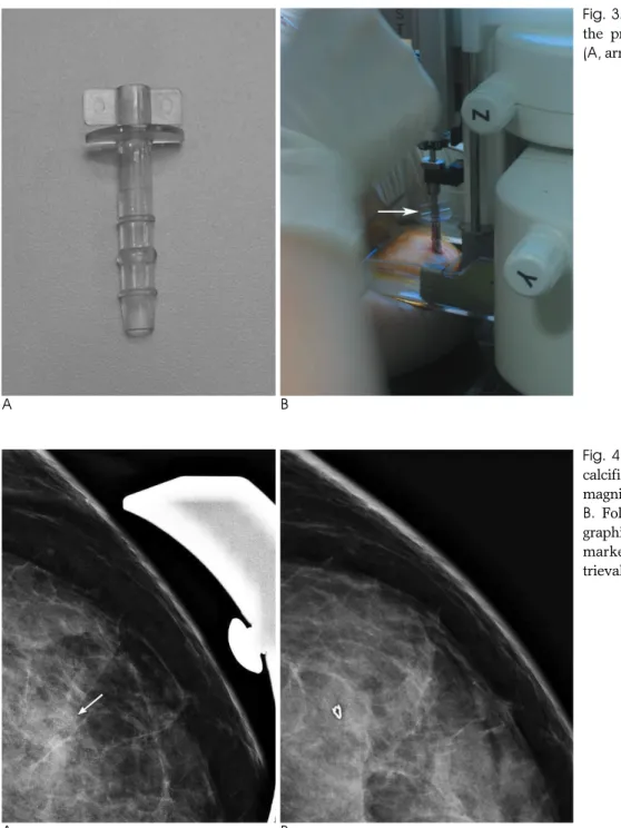 Fig. 3. To prevent of skin tear during the procedure, plastic skin protector (A, arrow in B) was applied.