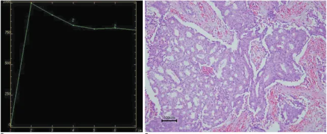 Fig. 1. F. Microscopic examination (hematoxylin-eosin stain, original magnification ×100) shows invasive carcinoma with a cribri- cribri-form pattern