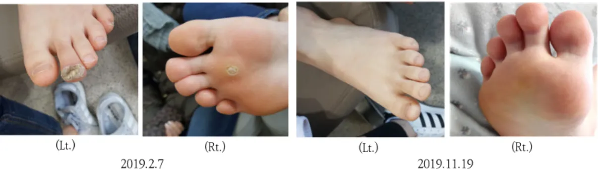 Fig.  2.  Changes  of  Verruca  vulgaris  in  Both  Feet  after  the  treatment