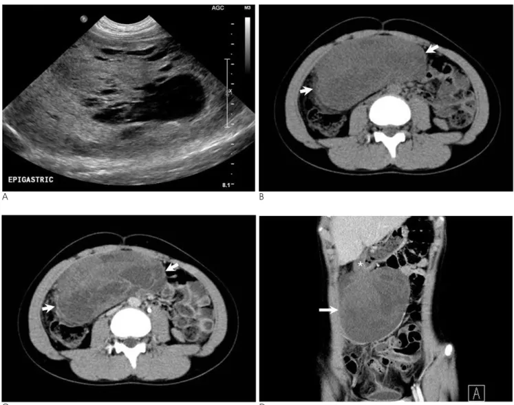 Fig. 1. A 12-year-old girl presented with a KIT-negative gastrointestinal stromal tumor of the stomach.