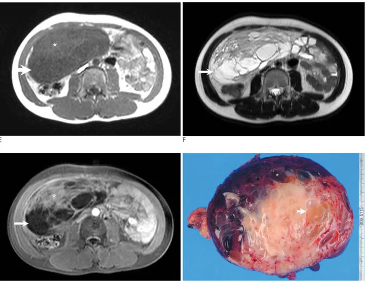Fig. 1. E-G. Axial T1-weighted MR image (E), T2-weighted MR image (F) and contrast-enhanced T1-weighted MR image (G) show a complex mass with cystic and solid regions