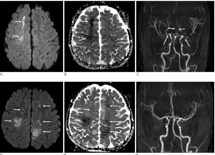 Fig. 1. Acute infarction with vasospasm caused by FK506 administration.