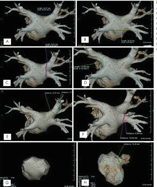 Fig. 1. Measurements of parameters in Afib group. (A) Superior roof, (B)  infe-rior roof, (C) right lateral wall, (D) left carina, (E) and (F) ostium of PV, and  di-ameter between ostium and first  seg-mental bifurcation, (G) LA volume, (H) ostium of LA ap