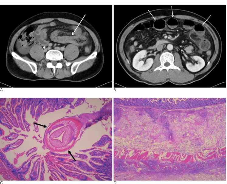Table 2. CT Findings of the Small Bowel Anisakiasis Patients  Case  Involved Site  Segmental Luminal 