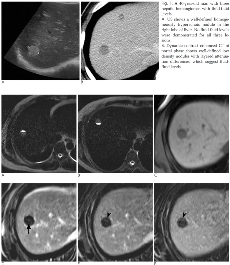 Fig. 2. MRI of the largest hemangioma with a fluid-fluid level.
