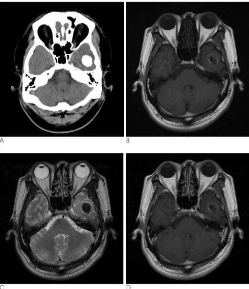 Fig. 1. CT and MR imaging show low grade astrocytoma in left temporal lobe. 