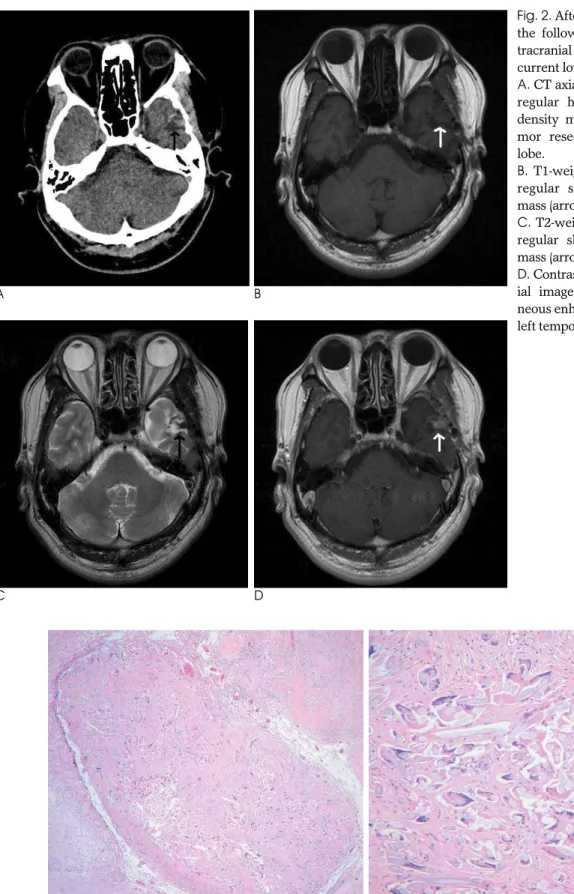 Fig. 3. Microscopic finding shows intracranial gossypiboma.