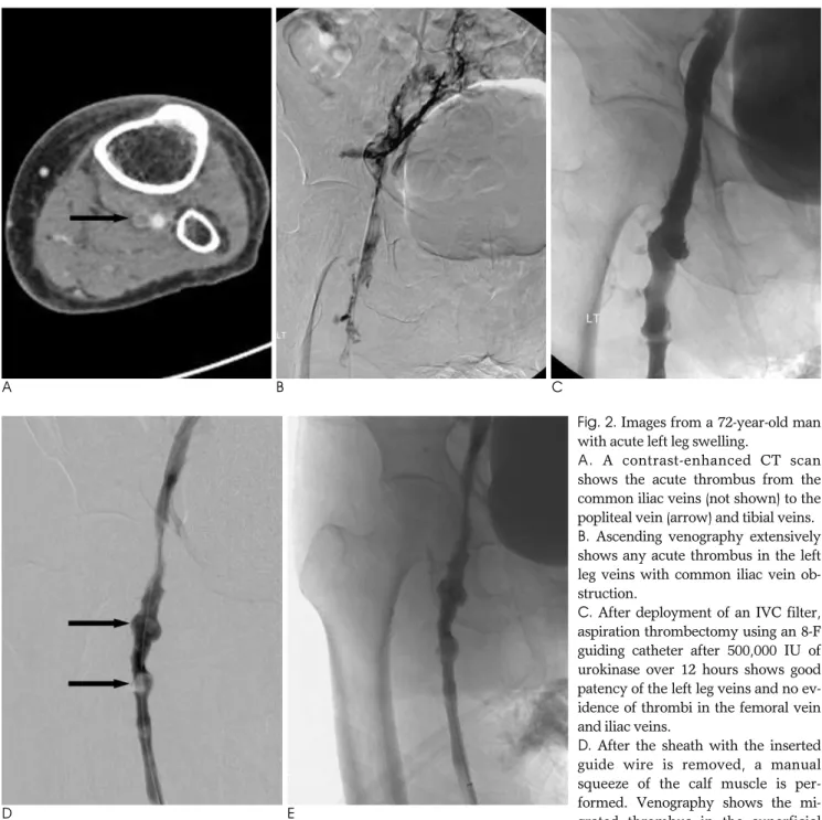 Fig. 2. Images from a 72-year-old man with acute left leg swelling. 