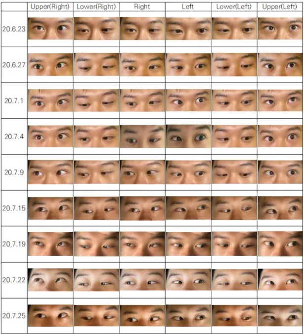 Fig.  1.  Change  in  both  eyeball  movement  according  to  treatment  duration