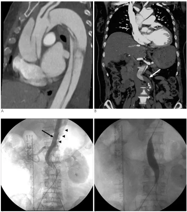 Fig. 1. A 61-year-old female with aortic dissection (Stanford type A).  