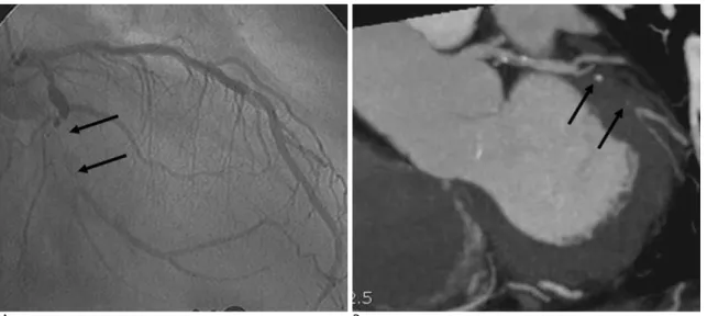 Fig. 1. A 71-year-old man with chest pain. Invasive coronary angiography (A) shows LCX plaque characterized by bulky, lucent le- le-sion with occlule-sion of distal LCX (arrows)