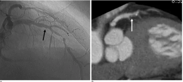 Fig. 3. A 78-year-old man with acute chest pain. Coronary angiogram (A) demonstrates severely irregular, stenotic lesion (black ar- ar-row) and occlusion (white arar-row) in the proximal and middle segment of RCA, respectively