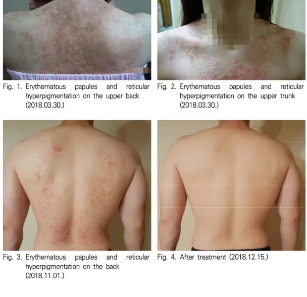 Fig. 1. Erythematous  papules  and  reticular  hyperpigmentation  on  the  upper  back  (2018.03.30.)