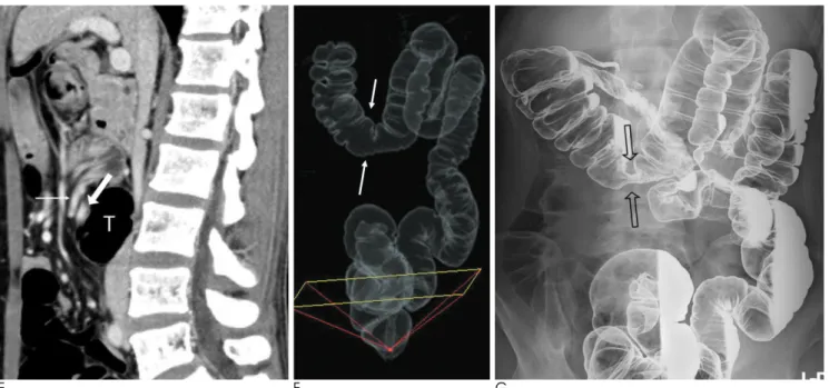 Fig. 1. E-G. The sagittal (F) reformatted image more clearly depicted the relationship between the superior mesenteric vessels (thin and thick arrows) and the transverse colon (T)