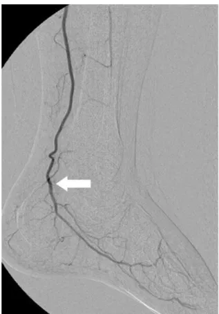 Fig. 1. A 38-year-old man with high-voltage electrical burn.