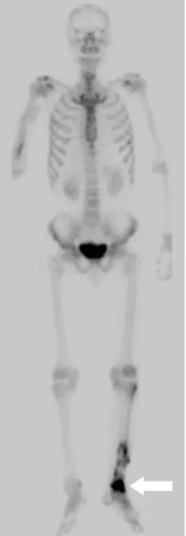 Fig. 3. Bone scan shows increased uptake in the left ankle joint (arrow).