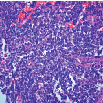 Fig.  3.  On immunohistochemical staining, the tumor cells showed diffuse, strong membranous positivity for CD99 (×