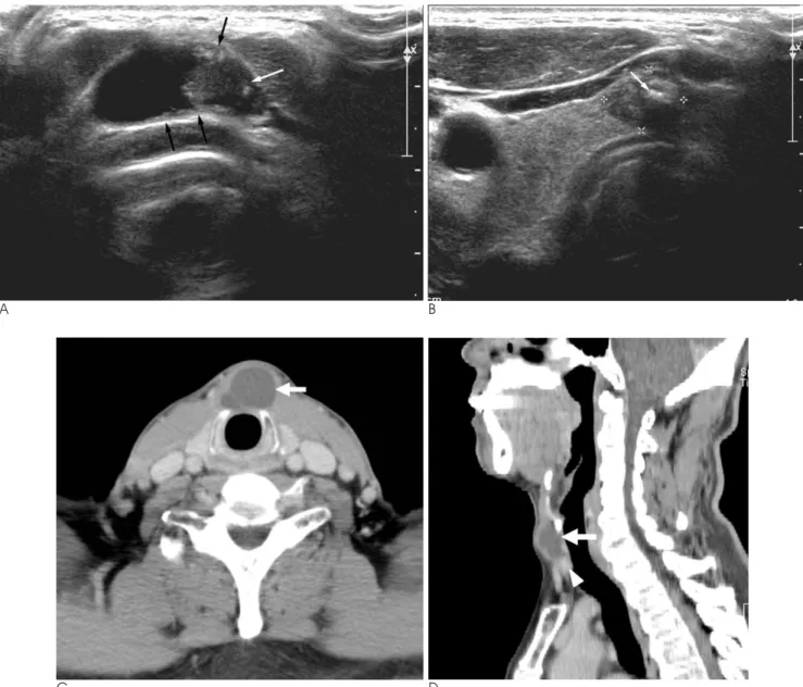 Fig. 1. Concurrent papillary carcinomas arising in the thyroglossal duct cyst and thyroid gland in a 67-year-old man.