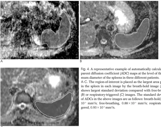 Fig. 4. A representative example of automatically calculated ap- ap-parent diffusion coefficient (ADC) maps at the level of the  maxi-mum diameter of the spleens in three different patients