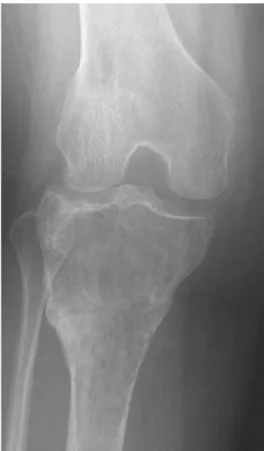 Fig.  2.  A year later, tumor lesion aggravates and pathologic fracture is combined.