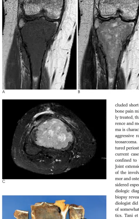 Fig.  3.  A,  B.  Coronal T1 (TR 590, TE 15) and T2 (TR 4011, TE  100)-weight-ed MR image shows low and  interme-diate signal intensity lesion confined to the tibia.