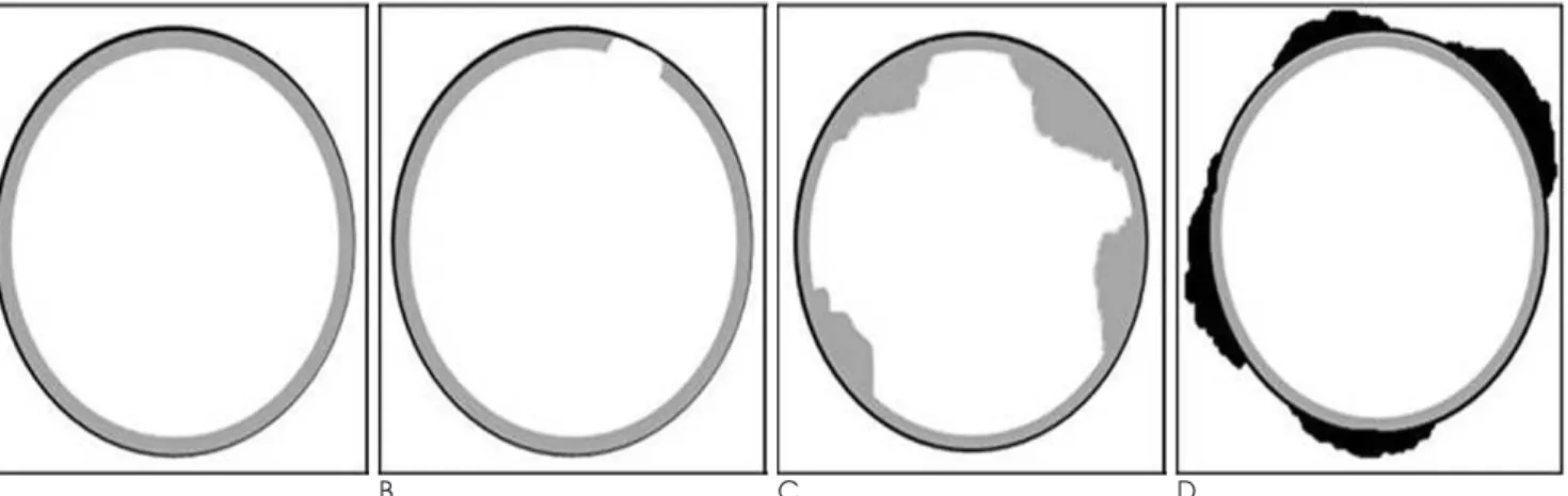 Fig. 2. A. A simple eggshell calcification in a 50-year-old woman.