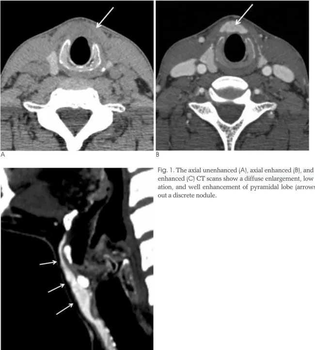 Fig. 1. The axial unenhanced (A), axial enhanced (B), and sagittal enhanced (C) CT scans show a diffuse enlargement, low  attenu-ation, and well enhancement of pyramidal lobe (arrows)  with-out a discrete nodule.