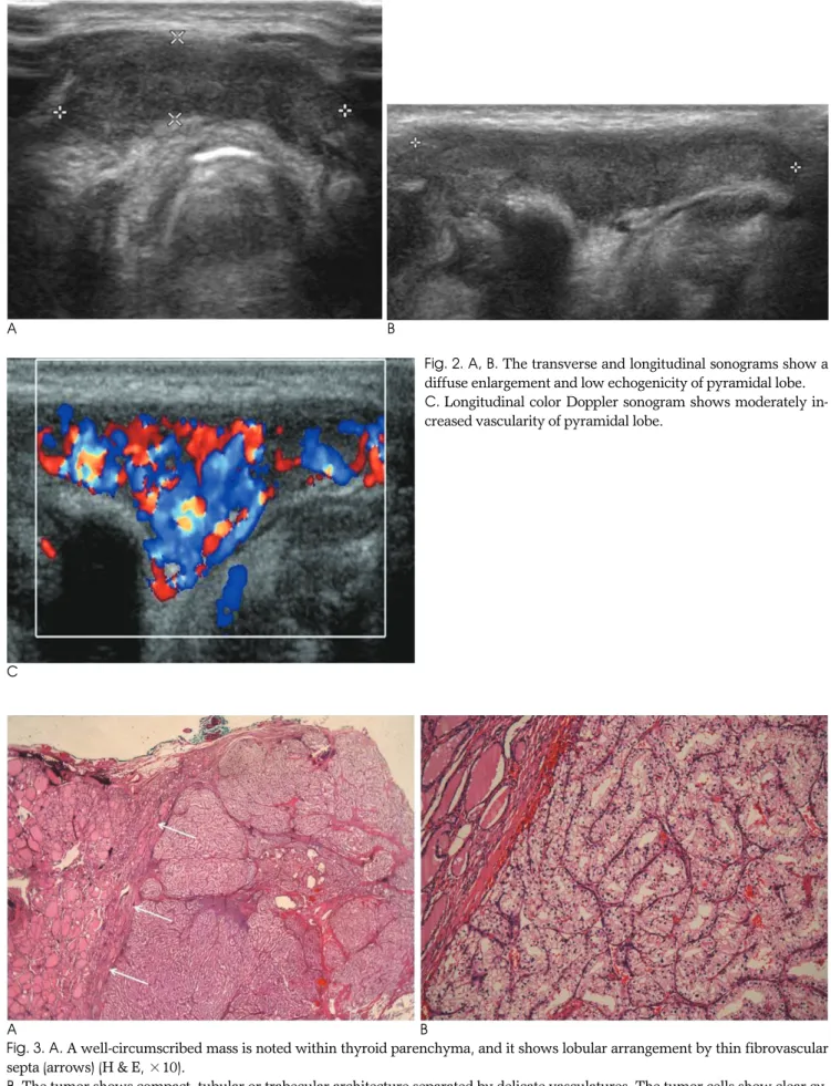 Fig. 2. A, B. The transverse and longitudinal sonograms show a diffuse enlargement and low echogenicity of pyramidal lobe