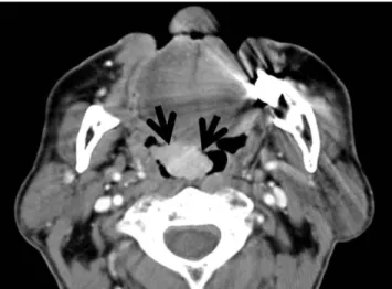 Fig. 2. An ocular myeloma in a 60-year-old man with extensive systemic manifestation of IgM multiple myeloma