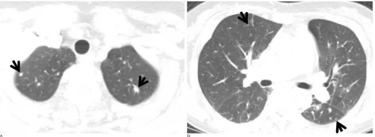 Fig. 5. Pleural IgM myeloma in a 60-year-old man. Enhanced CT scan (2.5-mm-section thickness) obtained at the atrial level shows bilateral pleural effusions