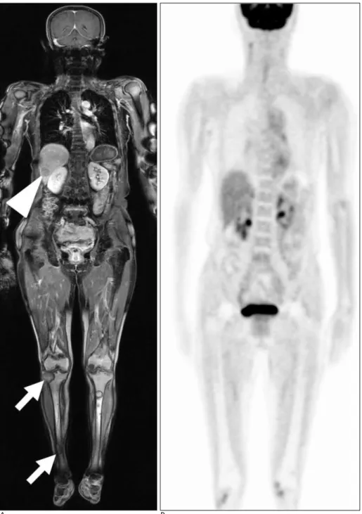Fig.  9. Biopsy-proven hepatic IgD myelomas in 69-year-old man.