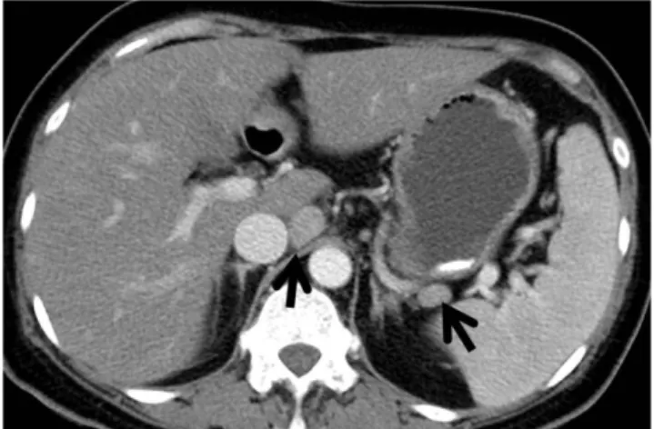 Fig. 13. Lymph node involvement of  light-chain myeloma in a 49-year-old woman. A contrast-enhanced CT scan  (5.0-mm-section thickness) obtained at the level of porta hepatis shows enlarged lymph nodes (arrows) around the caudate lobe of the liver and sple