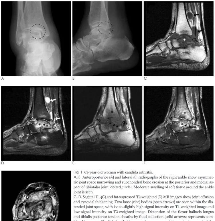 Fig. 1. 63-year-old woman with candida arthritis. 